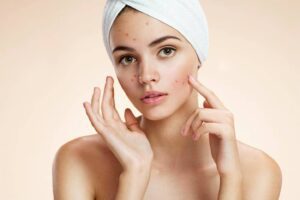 Botox for Crow’s Feet.