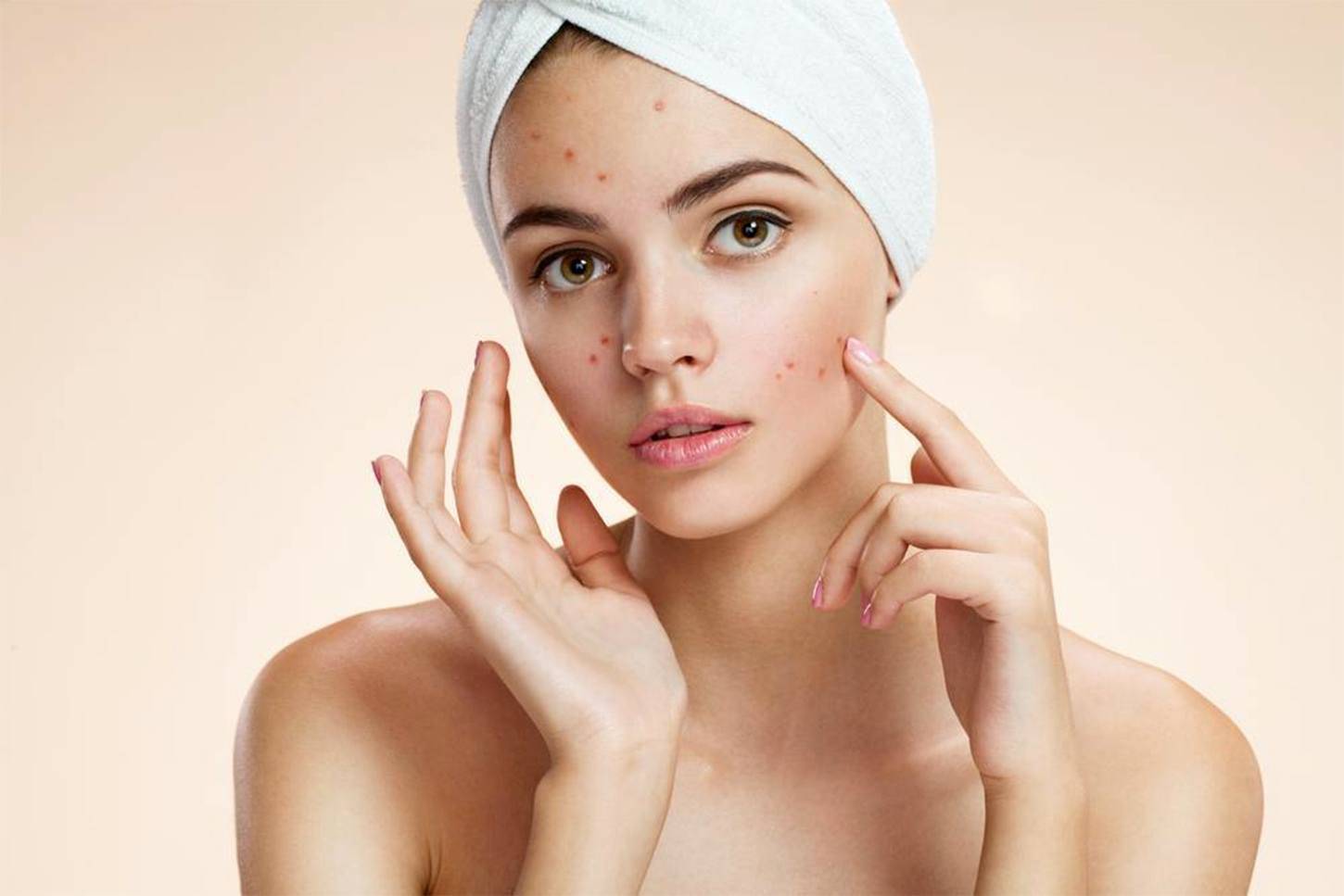 Botox for Crow’s Feet.