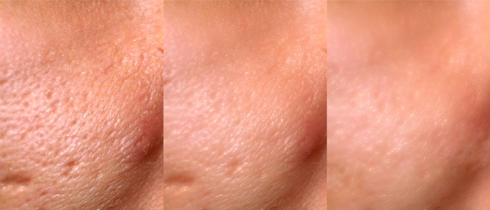 Acne Scar Revision - Innovative Acne Scar Treatments