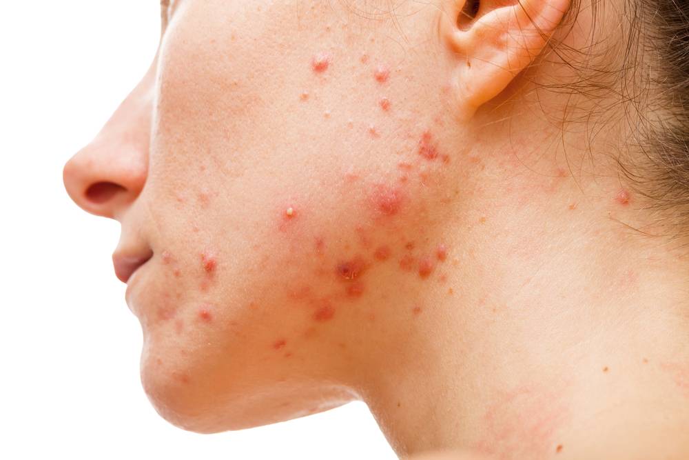 Acne Treatments: A Renaissance of Innovation and Understanding