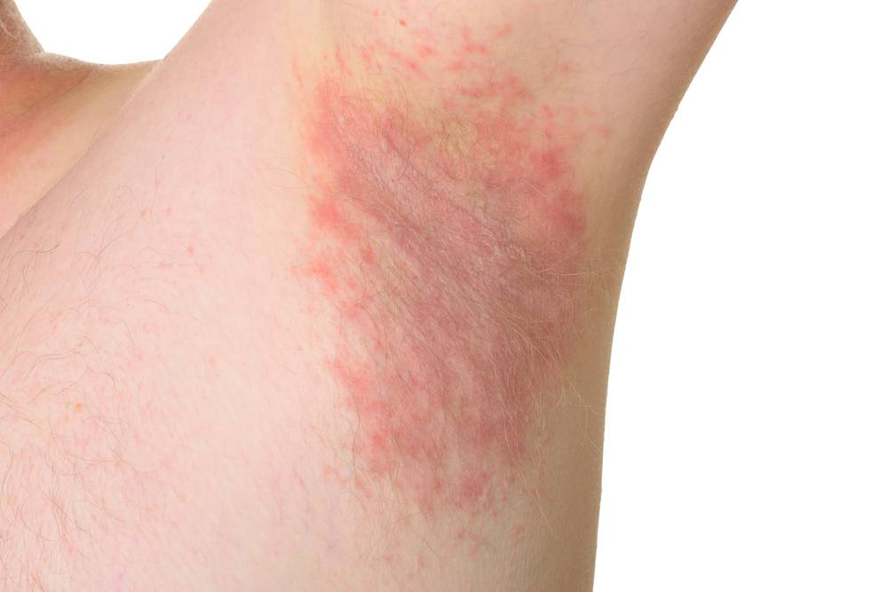 Armpit Rashes - Causes and Solutions