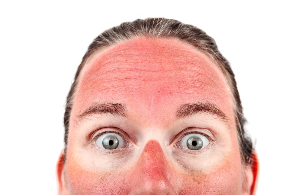 Sunburns: Healing, Myths, and Prevention Tips