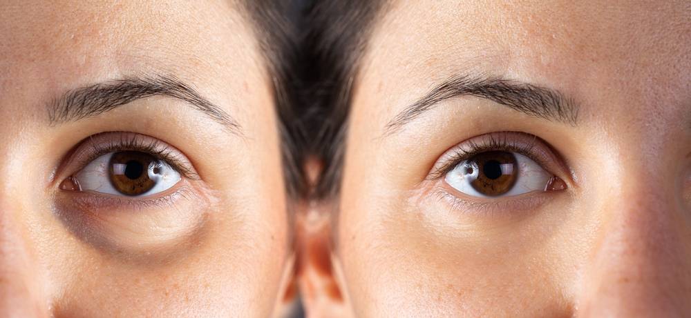 Which Under-Eye Filler Is Right for You?