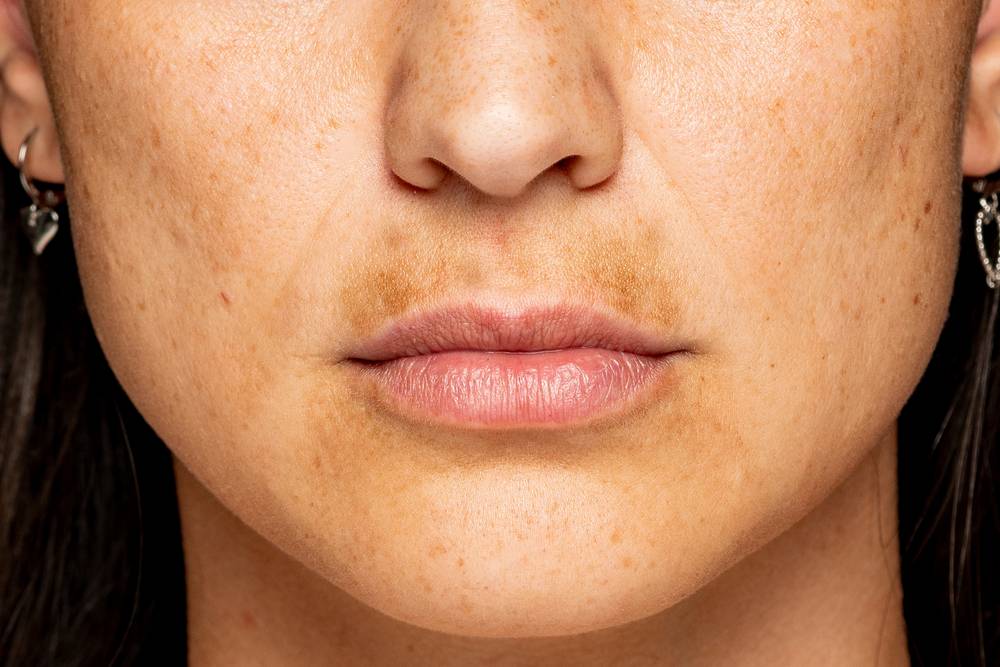 Understanding and Treating Skin Discoloration