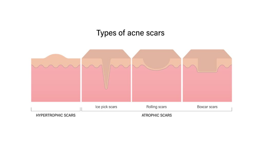 Acne Scar Treatments