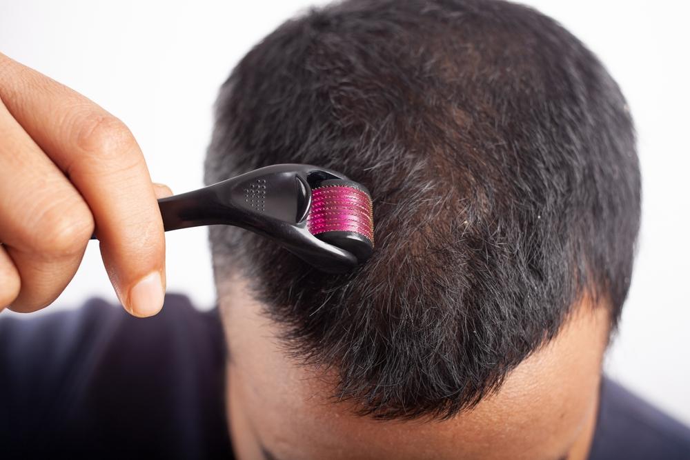 DermaRollers For Hair Loss Treatment