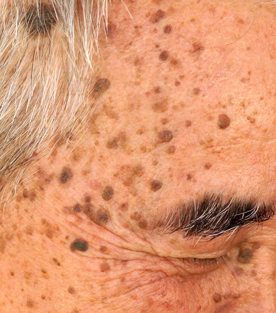 Seborrheic Keratosis In Miami Sullivan Dermatology